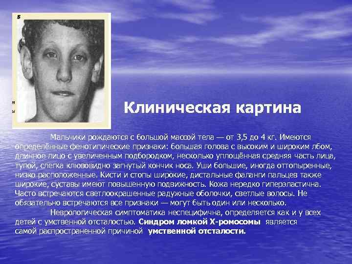 Клиническая картина Мальчики рождаются с большой массой тела — от 3, 5 до 4
