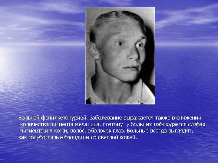Больной фенилкетонурией. Заболевание выражается также в снижении количества пигмента меланина, поэтому у больных наблюдается