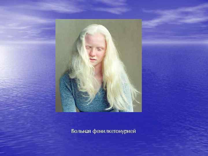 Больная фенилкетонурией 