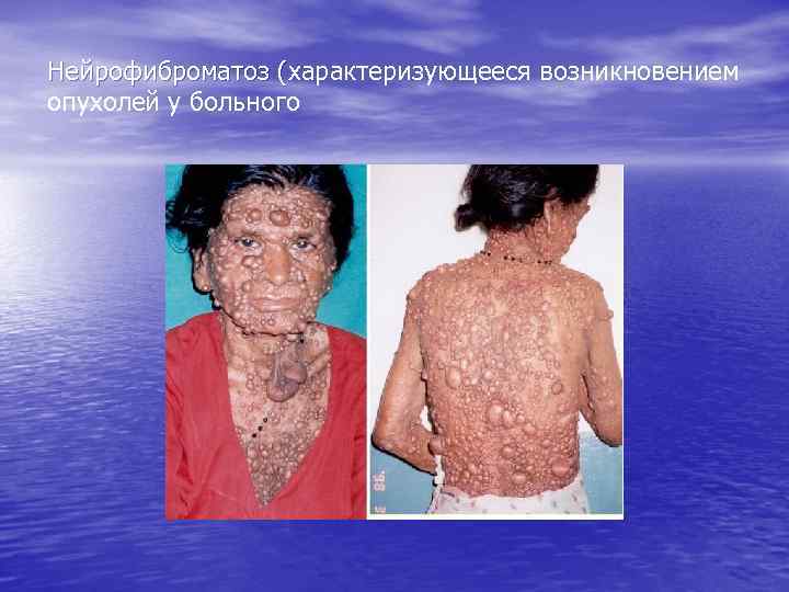 Нейрофиброматоз (характеризующееся возникновением Нейрофиброматоз ( опухолей у больного 