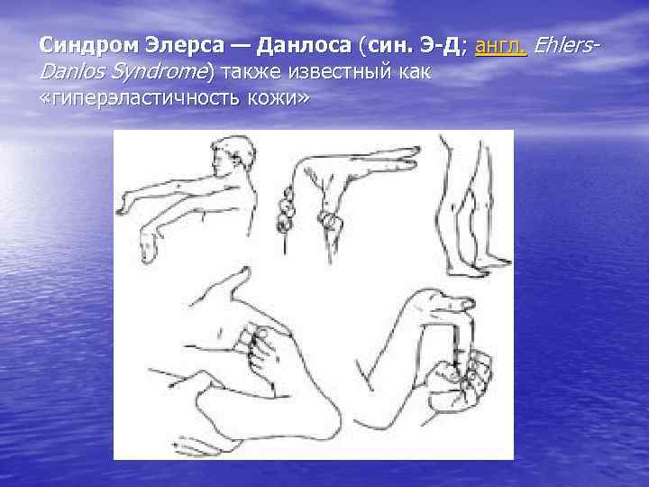 Синдром Элерса — Данлоса (син. Э-Д; англ. Ehlers. Danlos Syndrome) также известный как «гиперэластичность