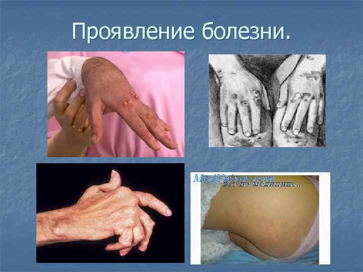 Проявление болезни. 