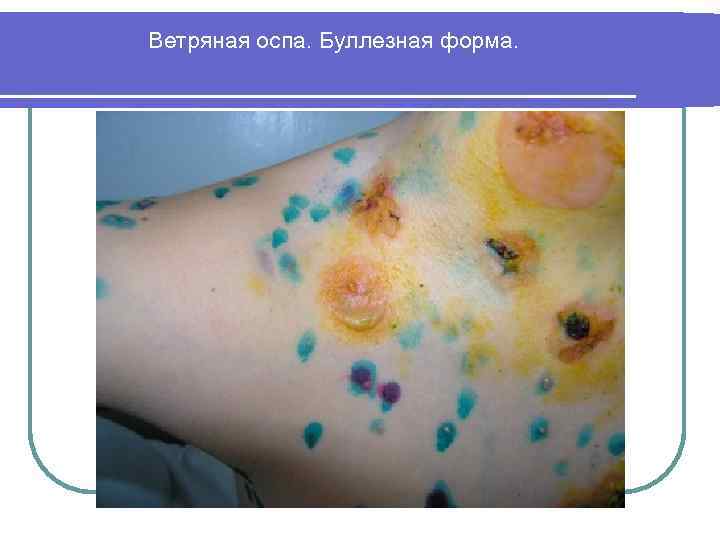 Ветряная оспа. Буллезная форма. 