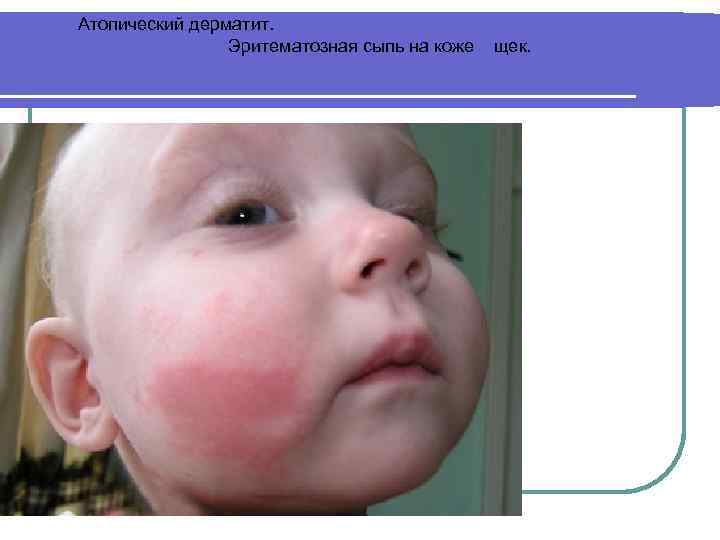 Атопический дерматит. Эритематозная сыпь на коже щек. 