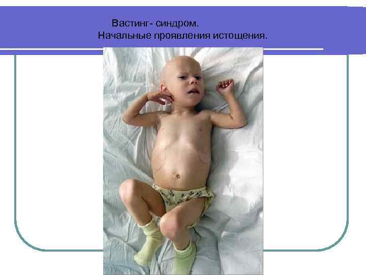  Вастинг- синдром. Начальные проявления истощения. 