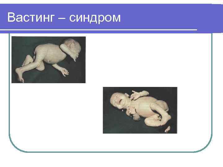 Вастинг – синдром 