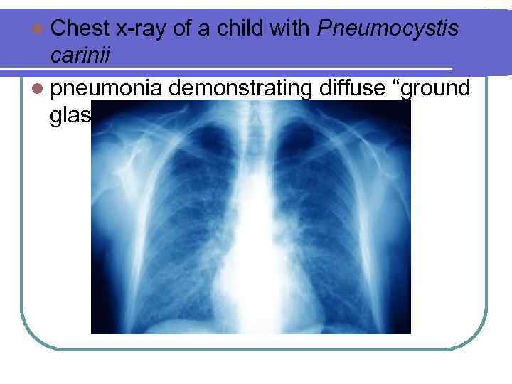 l Chest x-ray of a child with Pneumocystis carinii l pneumonia demonstrating diffuse “ground