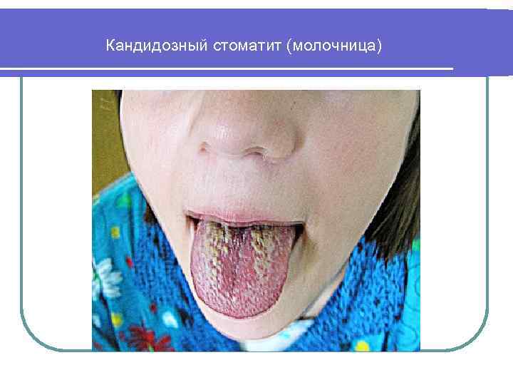  Кандидозный стоматит (молочница) 