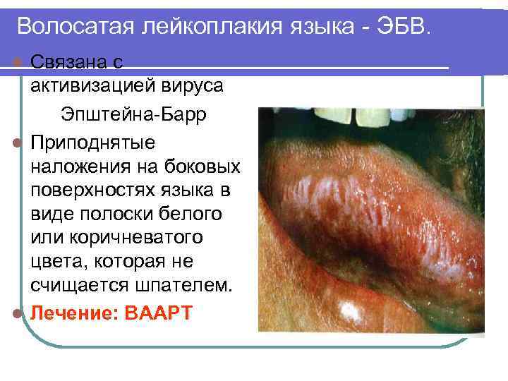 Волосатая лейкоплакия языка - ЭБВ. Связана с активизацией вируса Эпштейна-Барр l Приподнятые наложения на