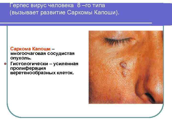 Герпес вирус человека 8 –го типа (вызывает развитие Саркомы Капоши). Саркома Капоши – многоочаговая