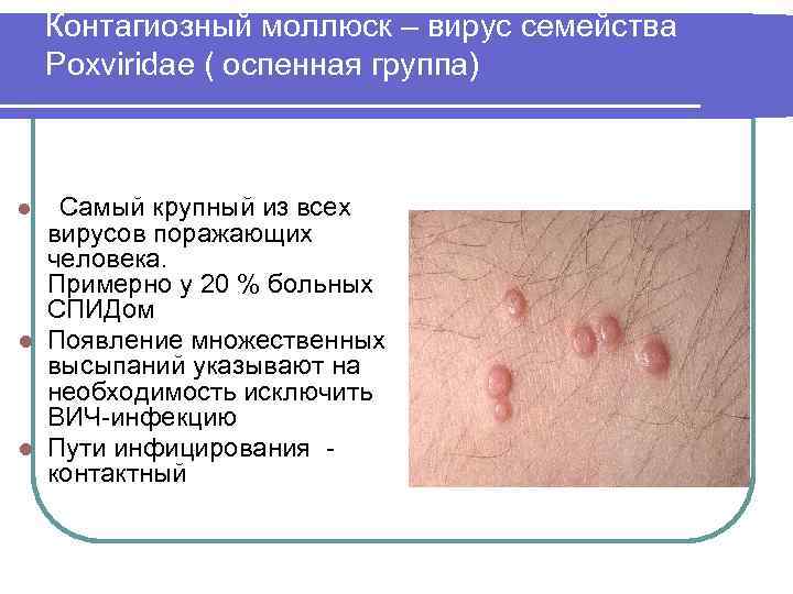 Контагиозный моллюск – вирус семейства Poxviridae ( оспенная группа) l Самый крупный из всех