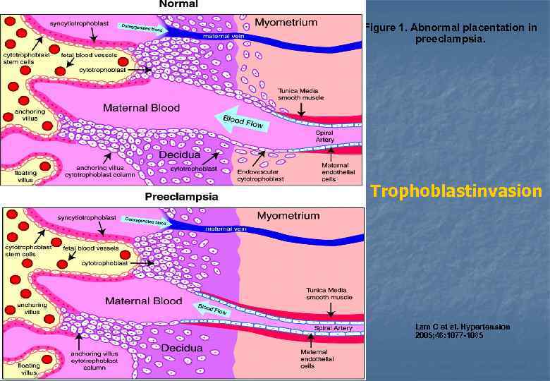 Figure 1. Abnormal placentation in preeclampsia. Trophoblastinvasion Lam C et al. Hypertension 2005; 46: