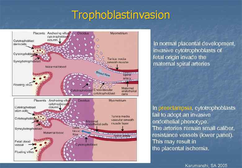 Trophoblastinvasion In normal placental development, invasive cytotrophoblasts of fetal origin invade the maternal spiral