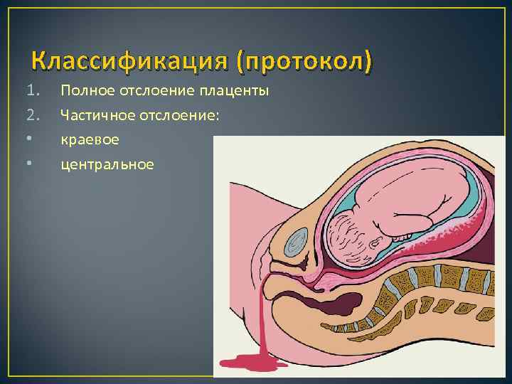 Классификация (протокол) 1. 2. • • Полное отслоение плаценты Частичное отслоение: краевое центральное 