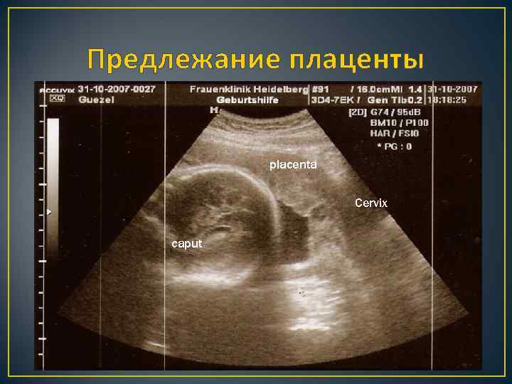 Предлежание плаценты placenta Cervix caput 