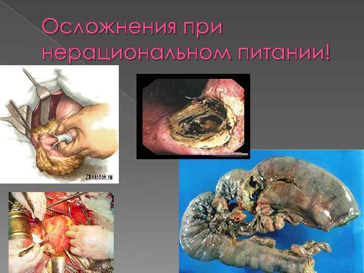 Осложнения при нерациональном питании! 