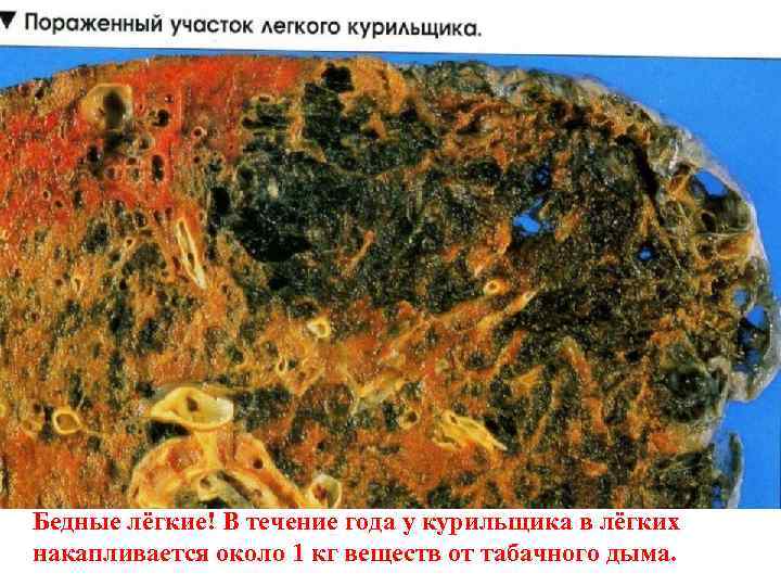 Бедные лёгкие! В течение года у курильщика в лёгких накапливается около 1 кг веществ