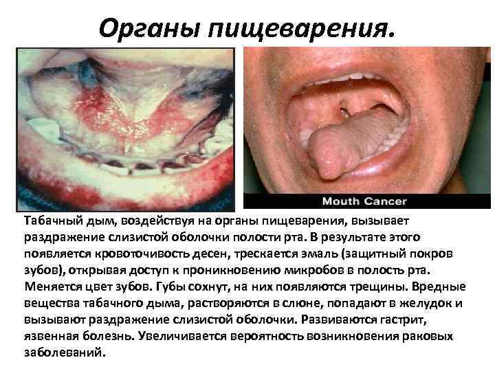 Органы пищеварения. Табачный дым, воздействуя на органы пищеварения, вызывает раздражение слизистой оболочки полости рта.