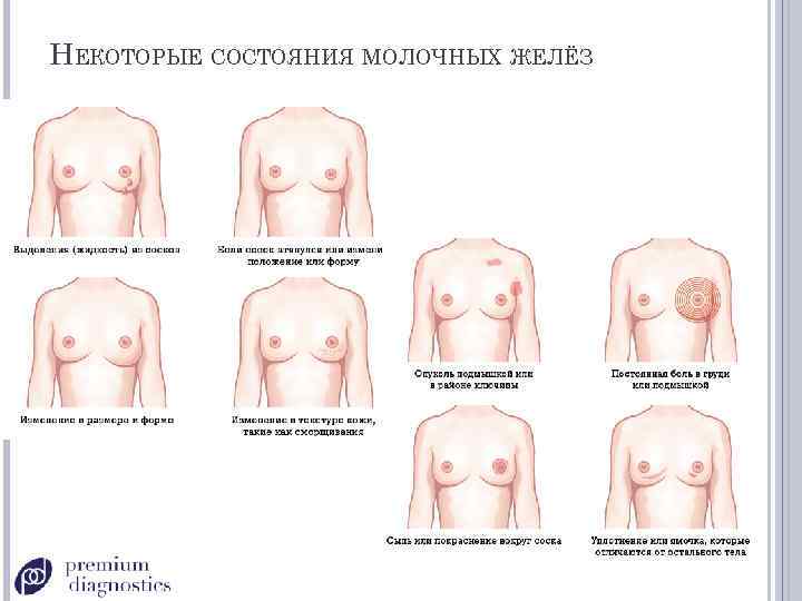 НЕКОТОРЫЕ СОСТОЯНИЯ МОЛОЧНЫХ ЖЕЛЁЗ 