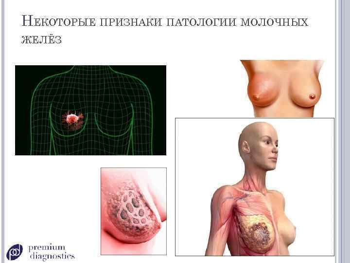 НЕКОТОРЫЕ ПРИЗНАКИ ПАТОЛОГИИ МОЛОЧНЫХ ЖЕЛЁЗ 