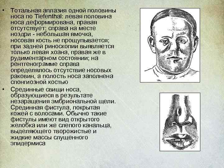 Правой левой носом. Гипоплазия\аплазия костей носа.. Аплазия костей носа у плода.