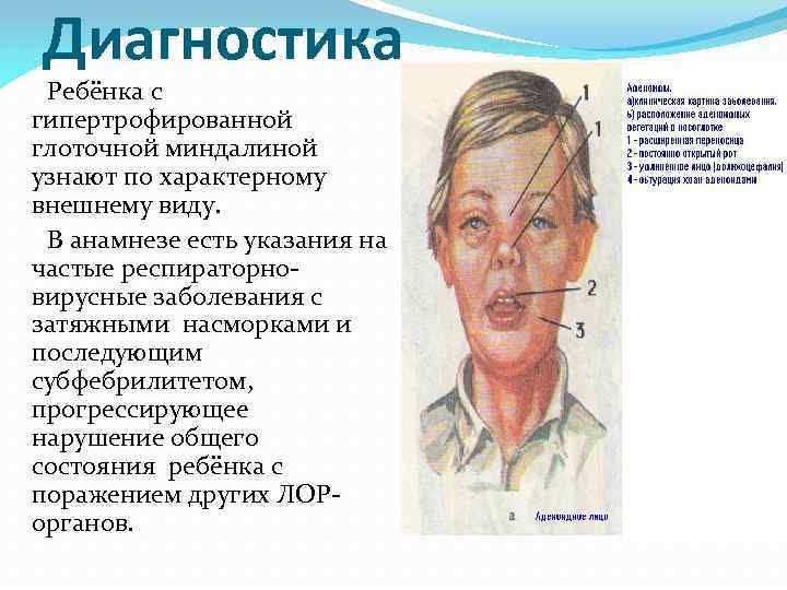 Диагностика Ребёнка с гипертрофированной глоточной миндалиной узнают по характерному внешнему виду. В анамнезе есть