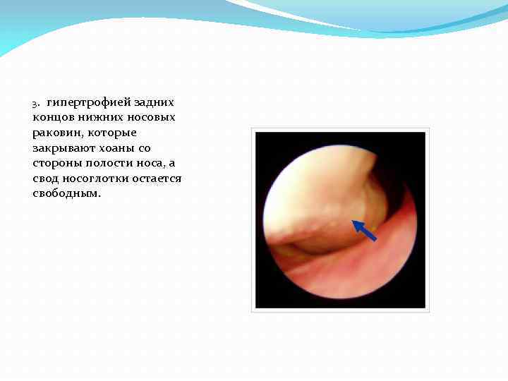 3. гипертрофией задних концов нижних носовых раковин, которые закрывают хоаны со стороны полости носа,