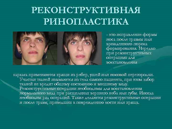 РЕКОНСТРУКТИВНАЯ РИНОПЛАСТИКА - это исправление формы носа после травмы или врожденного порока формирования. Нередко