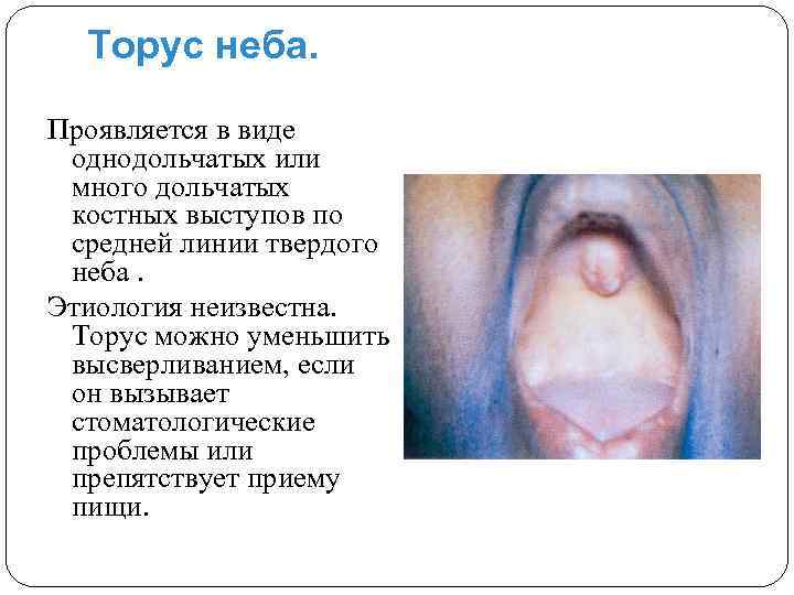 Торус неба. Проявляется в виде однодольчатых или много дольчатых костных выступов по средней линии