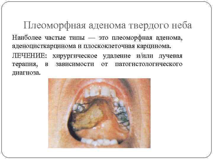 Плеоморфная аденома твердого неба Наиболее частые типы — это плеоморфная аденома, аденоцисткарцинома и плоскоклеточная