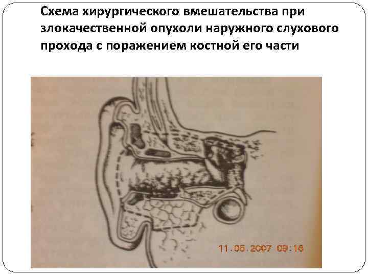Схема хирургического вмешательства при злокачественной опухоли наружного слухового прохода с поражением костной его части