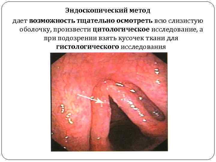 Эндоскопический метод дает возможность тщательно осмотреть всю слизистую оболочку, произвести цитологическое исследование, а при