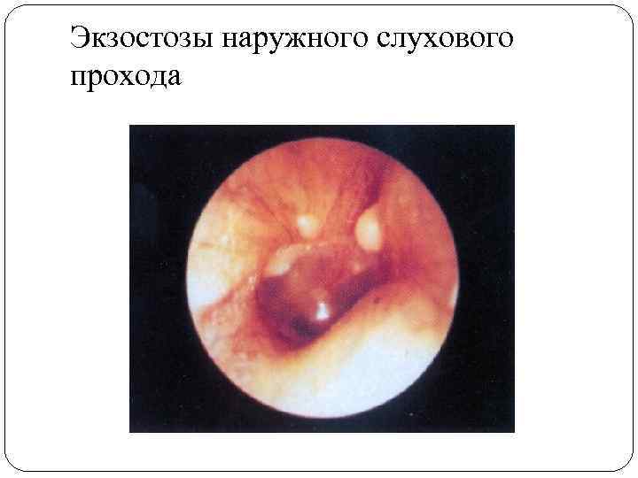 Экзостозы наружного слухового прохода 