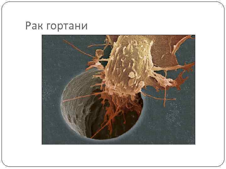 Рак гортани 