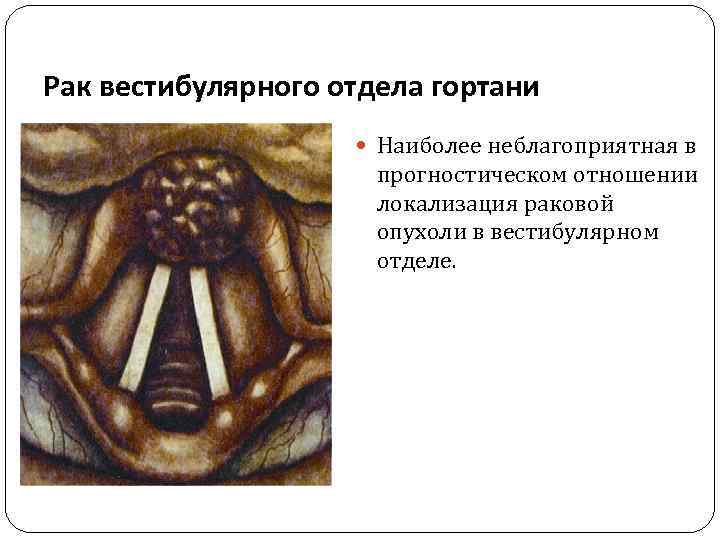 Рак вестибулярного отдела гортани Наиболее неблагоприятная в прогностическом отношении локализация раковой опухоли в вестибулярном
