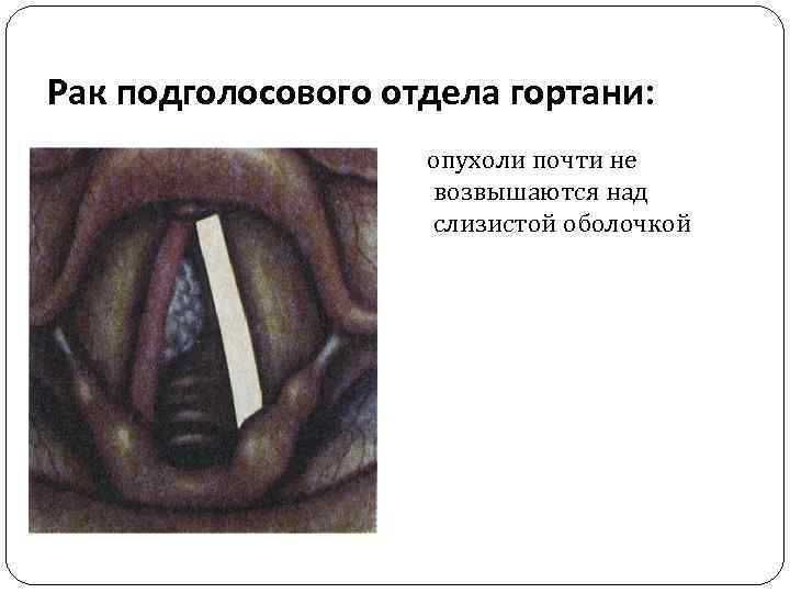Рак подголосового отдела гортани: опухоли почти не возвышаются над слизистой оболочкой 