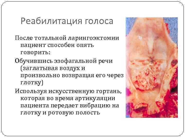 Реабилитация голоса После тотальной ларингоэктомии пациент способен опять говорить: Обучившись эзофагальной речи (заглатывая воздух