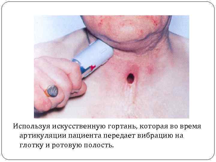 Используя искусственную гортань, которая во время артикуляции пациента передает вибрацию на глотку и ротовую