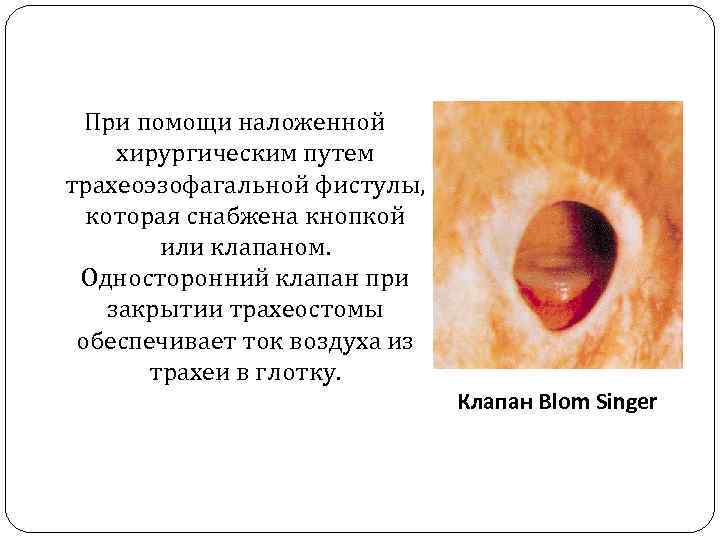 При помощи наложенной хирургическим путем трахеоэзофагальной фистулы, которая снабжена кнопкой или клапаном. Односторонний клапан