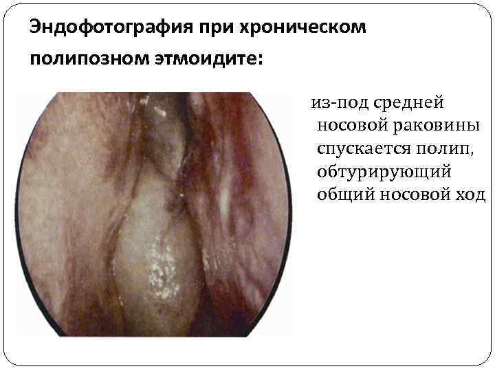 Эндофотография при хроническом полипозном этмоидите: из-под средней носовой раковины спускается полип, обтурирующий общий носовой