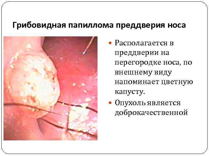 Грибовидная папиллома преддверия носа Располагается в преддверии на перегородке носа, по внешнему виду напоминает