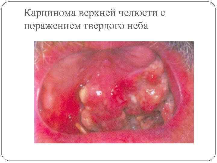 Карцинома верхней челюсти с поражением твердого неба 