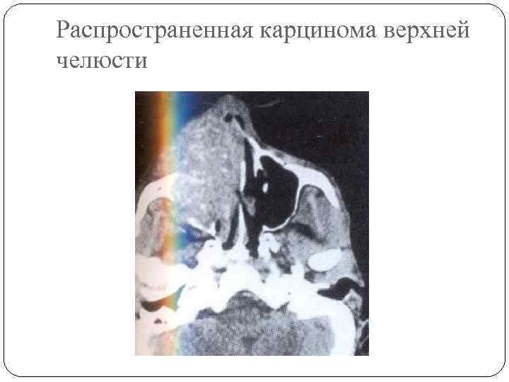 Распространенная карцинома верхней челюсти 