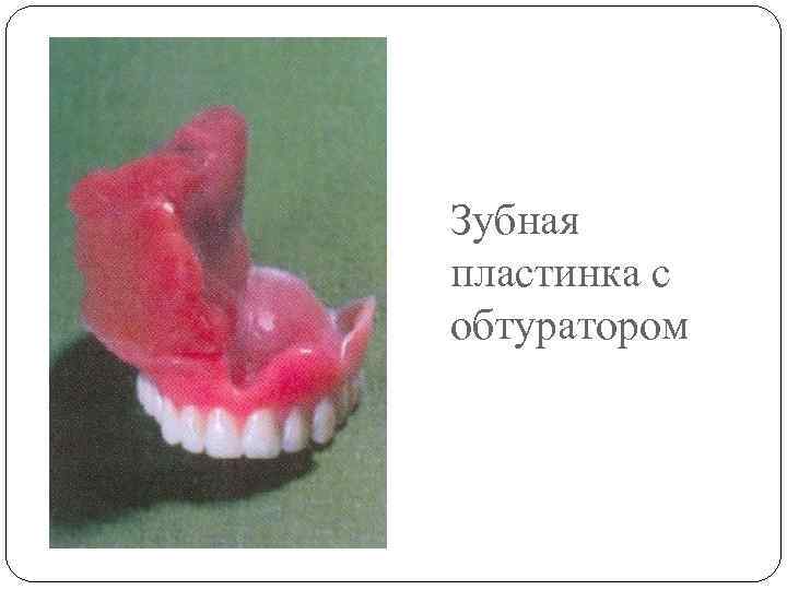Зубная пластинка с обтуратором 