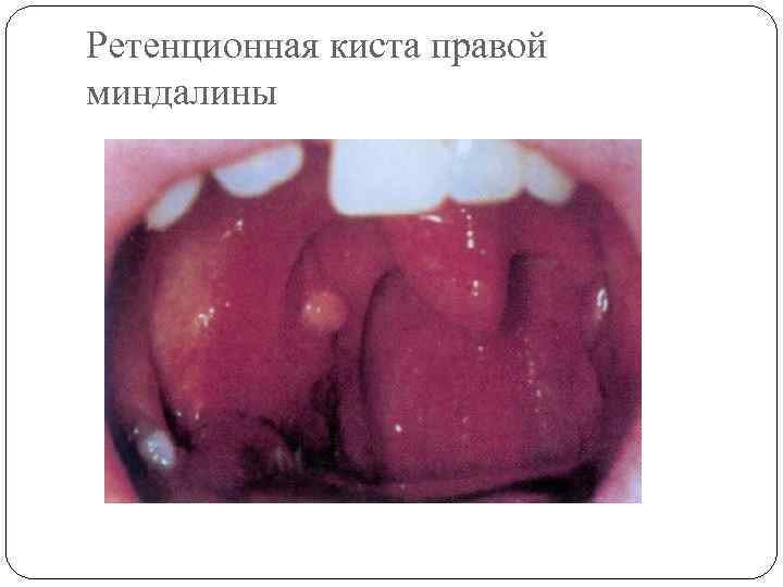 Ретенционная киста правой миндалины 