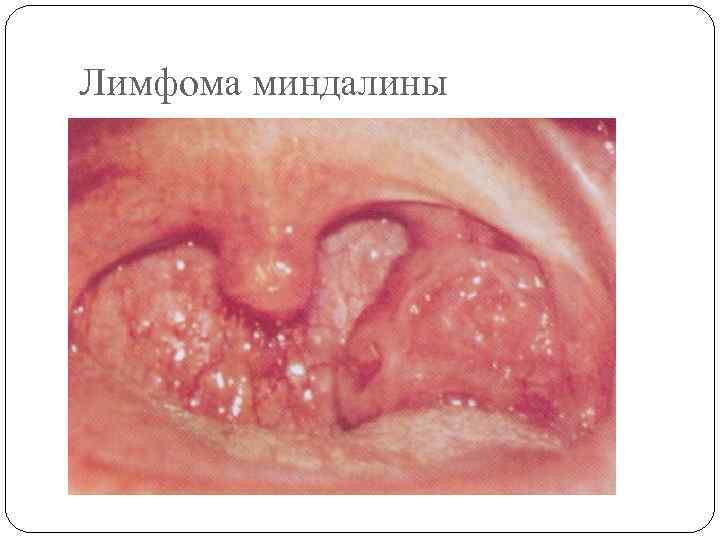 Лимфома миндалины 