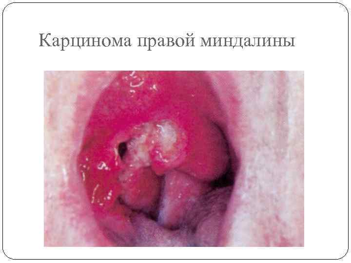 Карцинома правой миндалины 