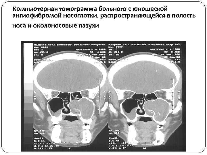 Компьютерная томограмма больного с юношеской ангиофибромой носоглотки, распространяющейся в полость носа и околоносовые пазухи