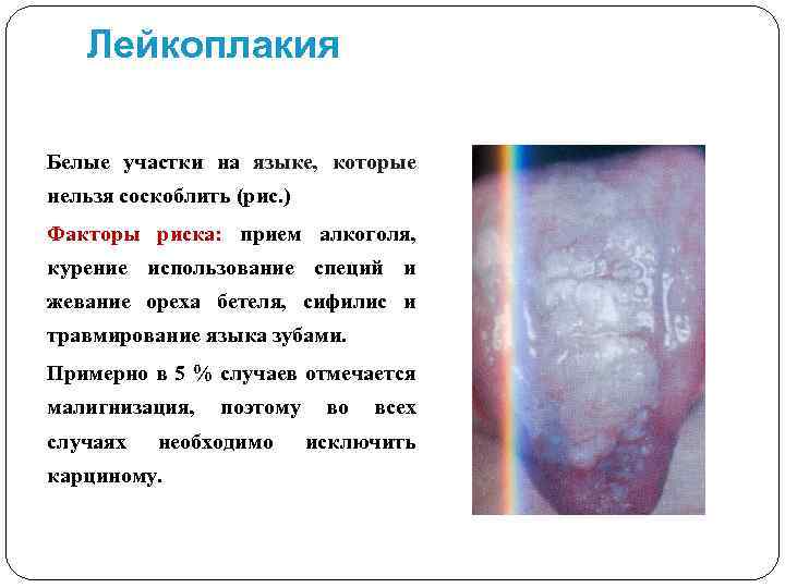 Лейкоплакия Белые участки на языке, которые нельзя соскоблить (рис. ) Факторы риска: прием алкоголя,