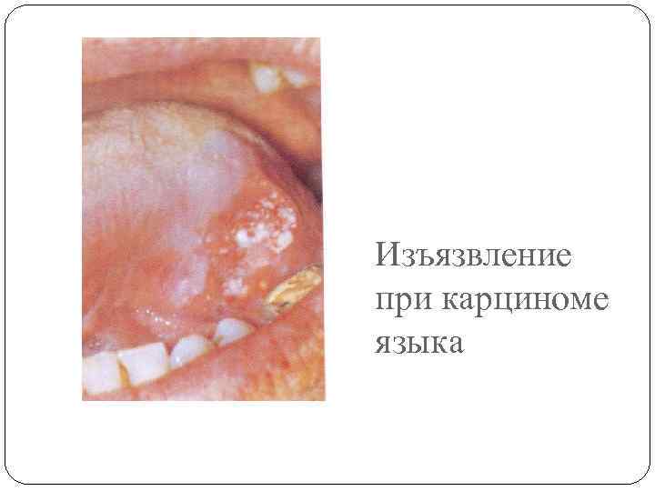 Изъязвление при карциноме языка 
